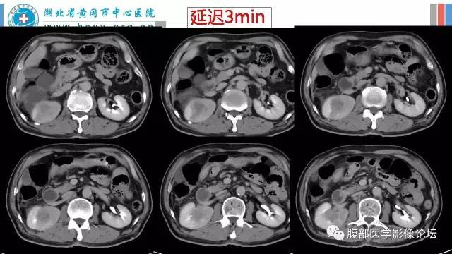 【病例】肾盂癌1例CT及MR影像表现 【病例】肾盂癌1例CT及MR影像表现