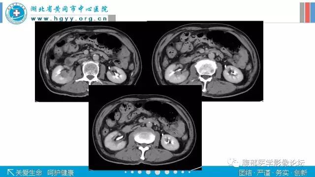 【病例】肾盂癌1例CT及MR影像表现 【病例】肾盂癌1例CT及MR影像表现
