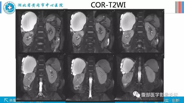 【病例】肾盂癌1例CT及MR影像表现 【病例】肾盂癌1例CT及MR影像表现