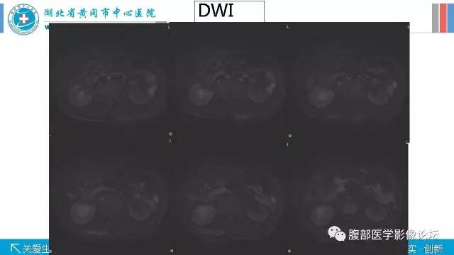 【病例】肾盂癌1例CT及MR影像表现 【病例】肾盂癌1例CT及MR影像表现