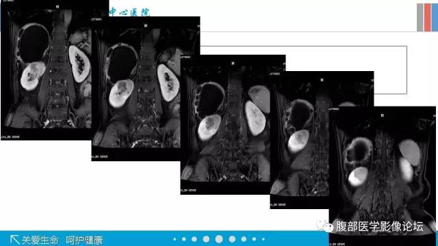 【病例】肾盂癌1例CT及MR影像表现 【病例】肾盂癌1例CT及MR影像表现