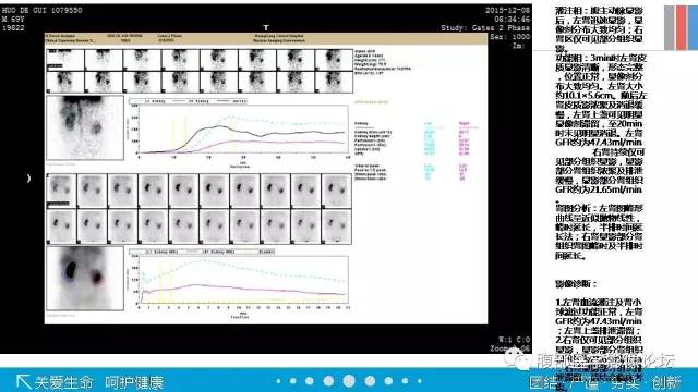 【病例】肾盂癌1例CT及MR影像表现 【病例】肾盂癌1例CT及MR影像表现