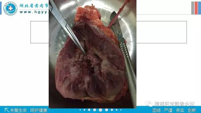 【病例】肾盂癌1例CT及MR影像表现 【病例】肾盂癌1例CT及MR影像表现