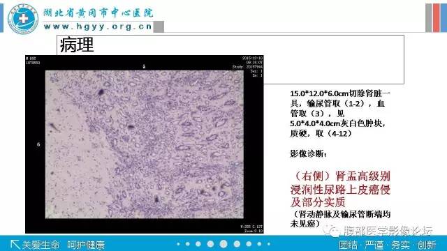 【病例】肾盂癌1例CT及MR影像表现 【病例】肾盂癌1例CT及MR影像表现