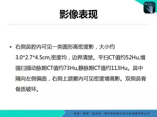 【病例分析】鼻腔血管瘤1例CT影像表现