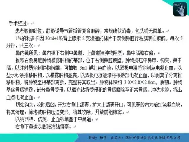 【病例分析】鼻腔血管瘤1例CT影像表现