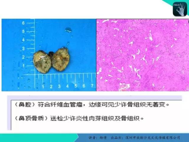 【病例分析】鼻腔血管瘤1例CT影像表现