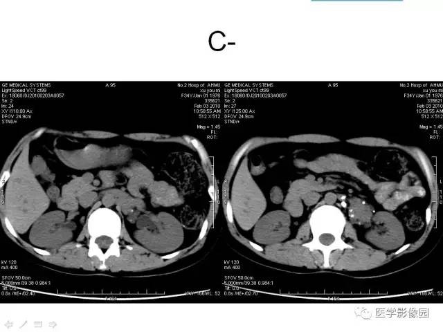 【病例】腹膜后静脉性海绵状血管瘤1例CT影像表现 【病例】腹膜后静脉性海绵状血管瘤1例CT影像表现