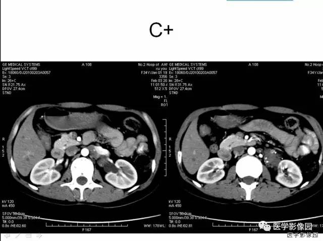 【病例】腹膜后静脉性海绵状血管瘤1例CT影像表现 【病例】腹膜后静脉性海绵状血管瘤1例CT影像表现