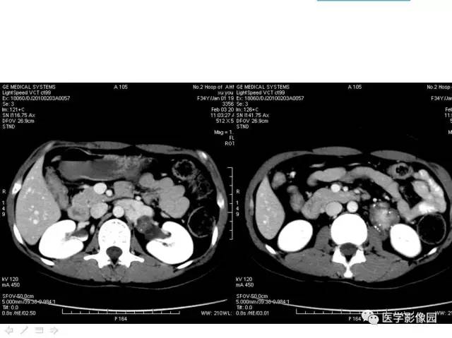 【病例】腹膜后静脉性海绵状血管瘤1例CT影像表现 【病例】腹膜后静脉性海绵状血管瘤1例CT影像表现