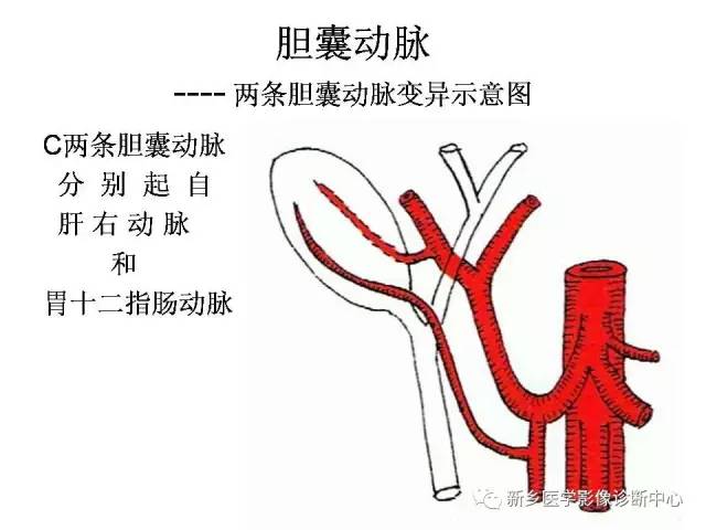 胆囊动脉的解剖和变异