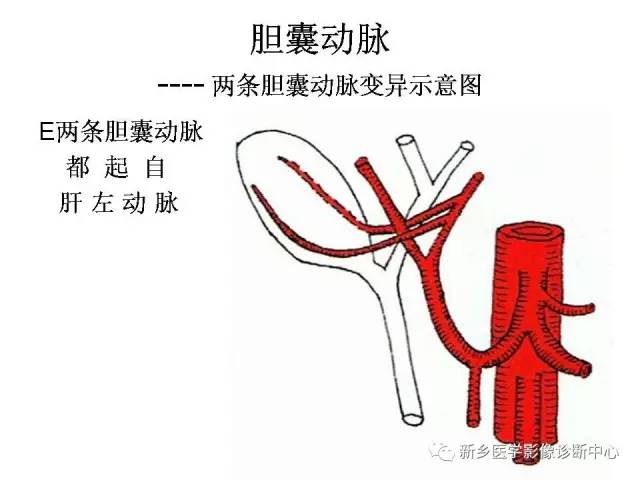 胆囊动脉的解剖和变异