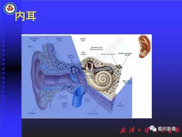 【PPT】先天性内耳畸形影像诊断