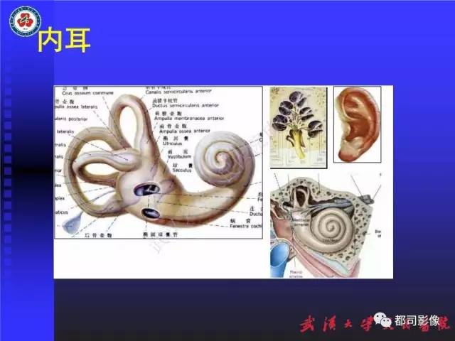 【PPT】先天性内耳畸形影像诊断