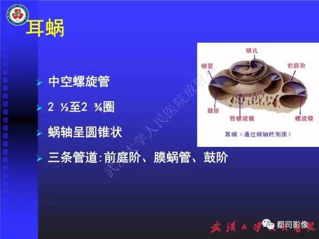 【PPT】先天性内耳畸形影像诊断