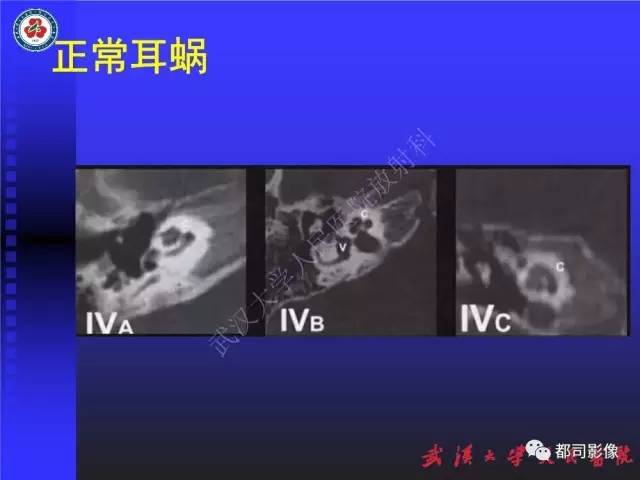 【PPT】先天性内耳畸形影像诊断