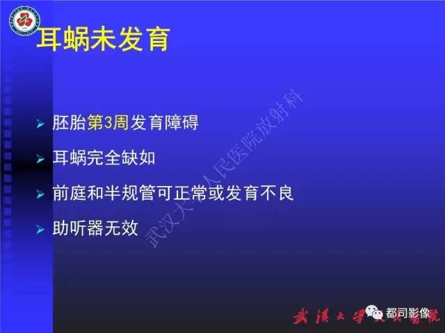 【PPT】先天性内耳畸形影像诊断