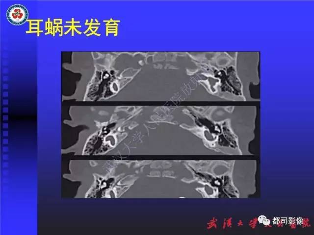 【PPT】先天性内耳畸形影像诊断