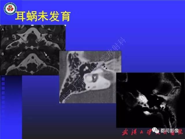 【PPT】先天性内耳畸形影像诊断