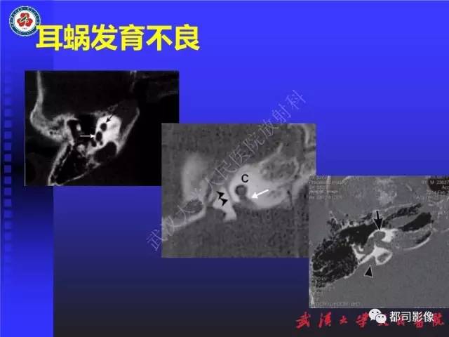 【PPT】先天性内耳畸形影像诊断