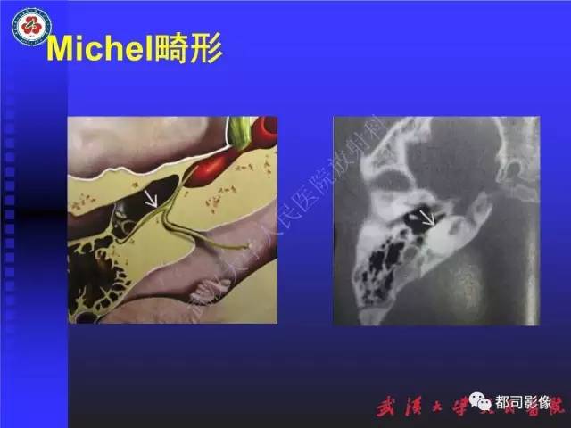 【PPT】先天性内耳畸形影像诊断