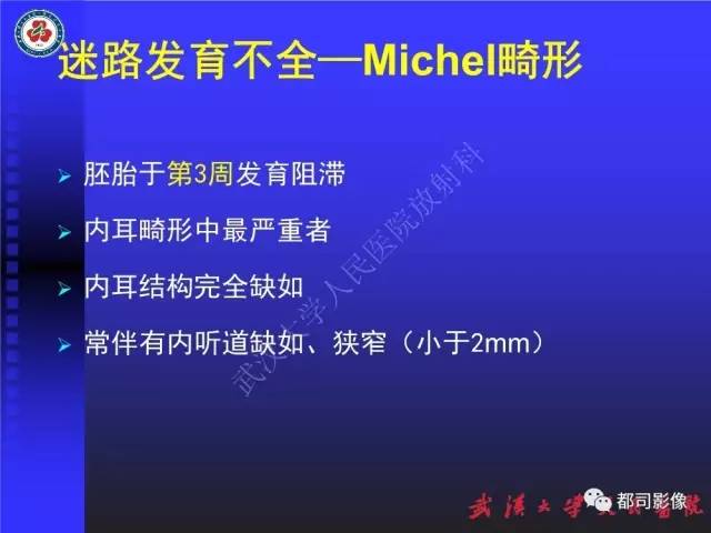 【PPT】先天性内耳畸形影像诊断