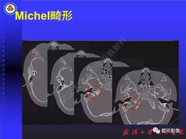 【PPT】先天性内耳畸形影像诊断