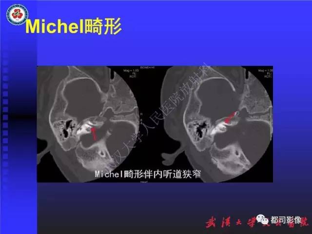【PPT】先天性内耳畸形影像诊断