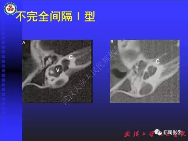 【PPT】先天性内耳畸形影像诊断