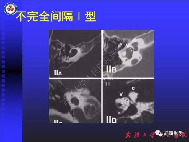 【PPT】先天性内耳畸形影像诊断