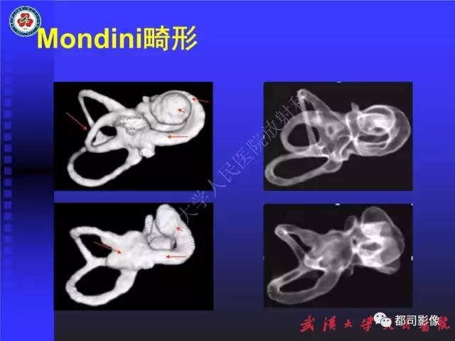 【PPT】先天性内耳畸形影像诊断