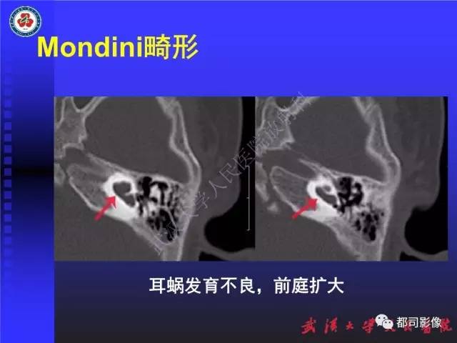 【PPT】先天性内耳畸形影像诊断