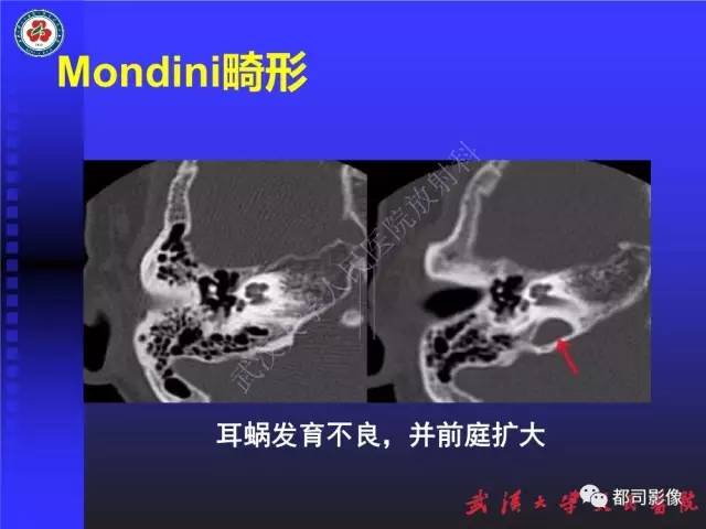 【PPT】先天性内耳畸形影像诊断