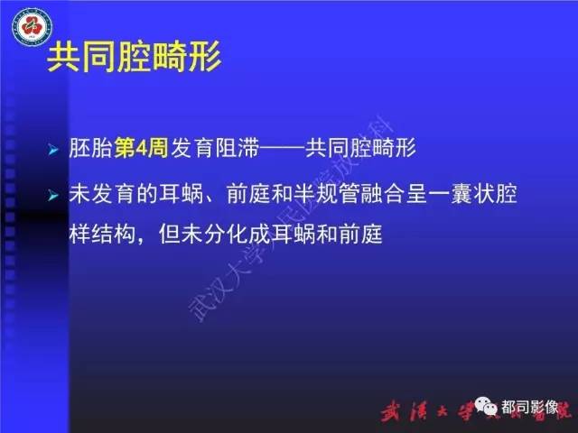 【PPT】先天性内耳畸形影像诊断