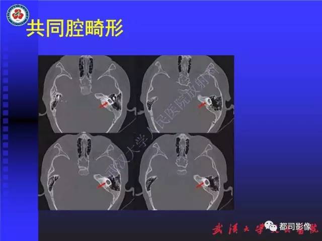 【PPT】先天性内耳畸形影像诊断