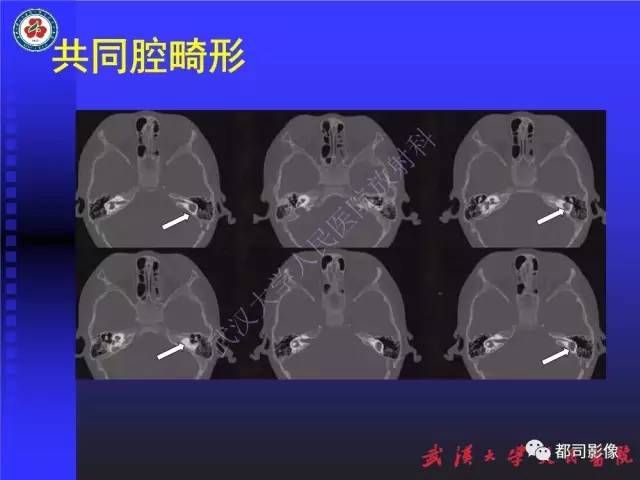 【PPT】先天性内耳畸形影像诊断