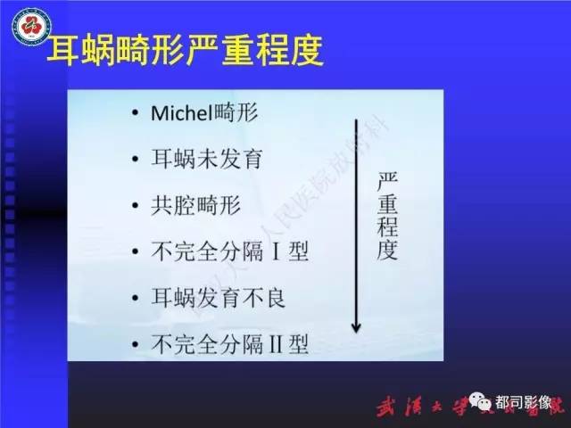 【PPT】先天性内耳畸形影像诊断