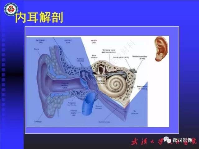 【PPT】先天性内耳畸形影像诊断