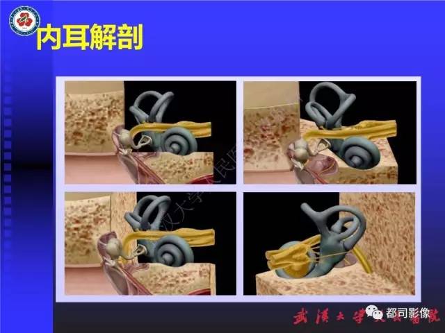 【PPT】先天性内耳畸形影像诊断