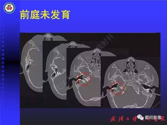 【PPT】先天性内耳畸形影像诊断