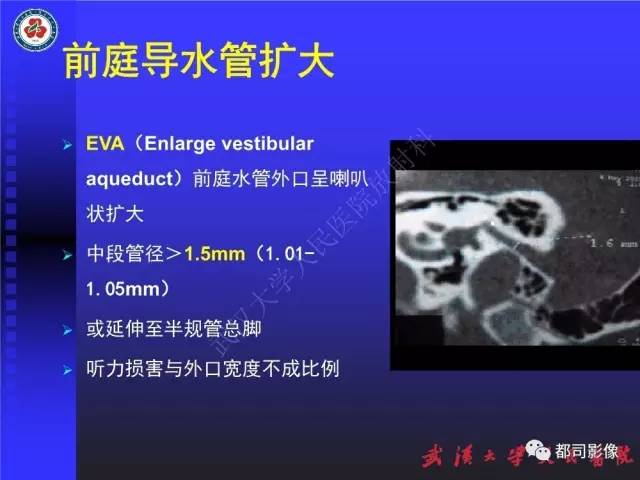 【PPT】先天性内耳畸形影像诊断