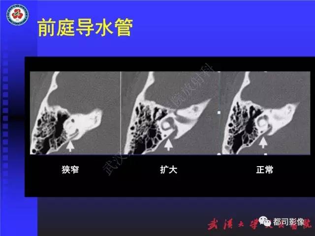 【PPT】先天性内耳畸形影像诊断