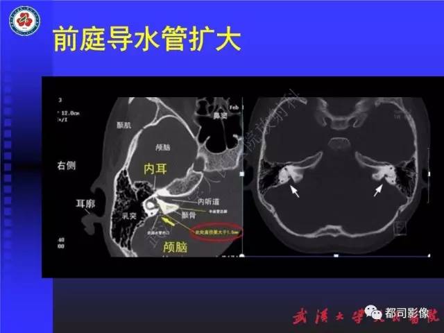 【PPT】先天性内耳畸形影像诊断