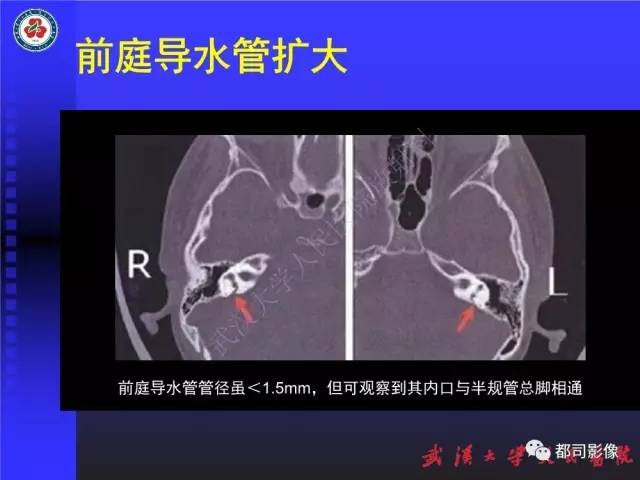 【PPT】先天性内耳畸形影像诊断