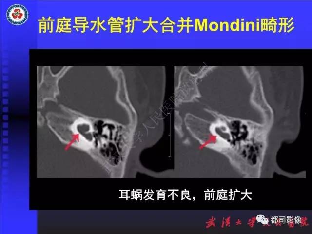 【PPT】先天性内耳畸形影像诊断