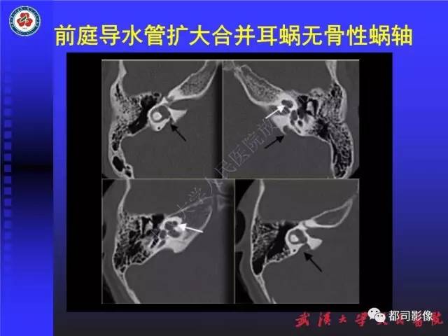 【PPT】先天性内耳畸形影像诊断