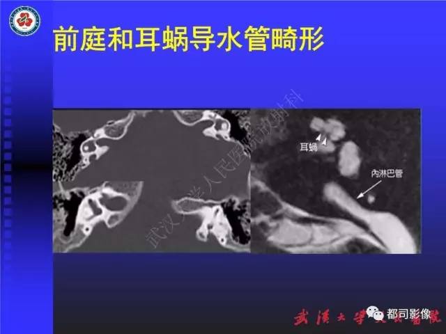 【PPT】先天性内耳畸形影像诊断
