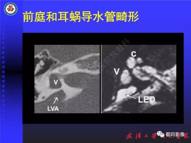【PPT】先天性内耳畸形影像诊断