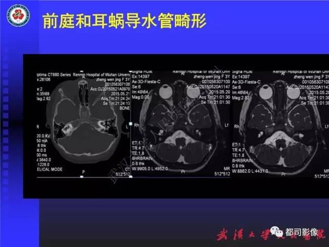 【PPT】先天性内耳畸形影像诊断