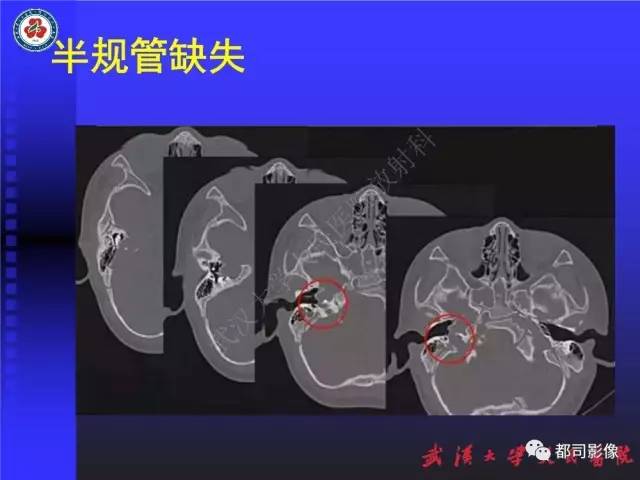 【PPT】先天性内耳畸形影像诊断